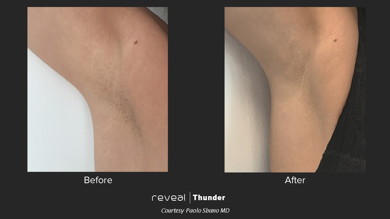 thunder before and after 2