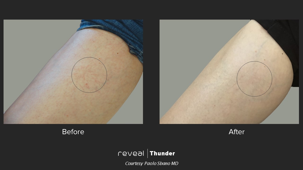 thunder before and after 3